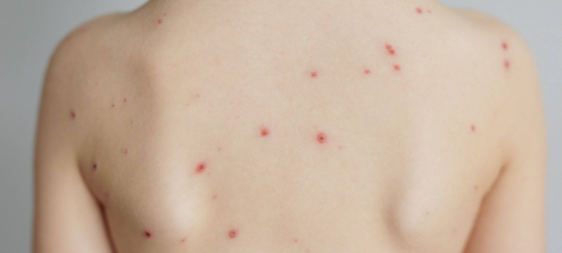 KREIS: Steigende Zahl an Windpocken-Fällen